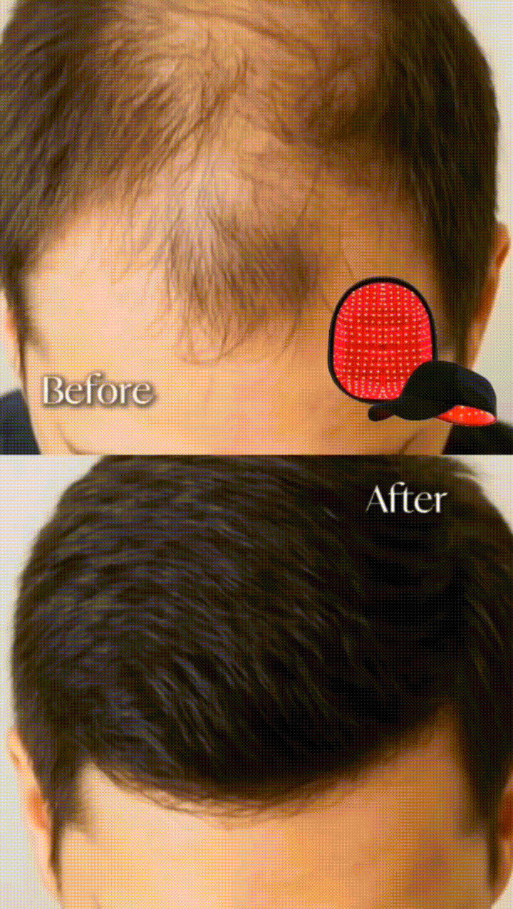 Before and after Selloraa hair growth therapy